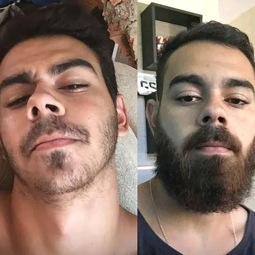 la solution à ton problème de cheveux et barbe