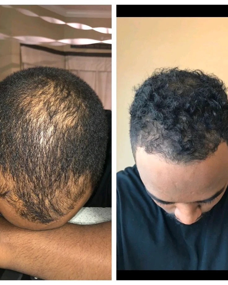 la solution à ton problème de cheveux et barbe