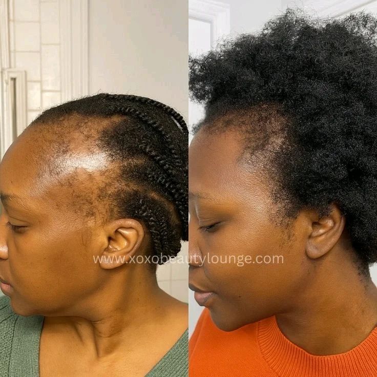 la solution à ton problème de cheveux et barbe